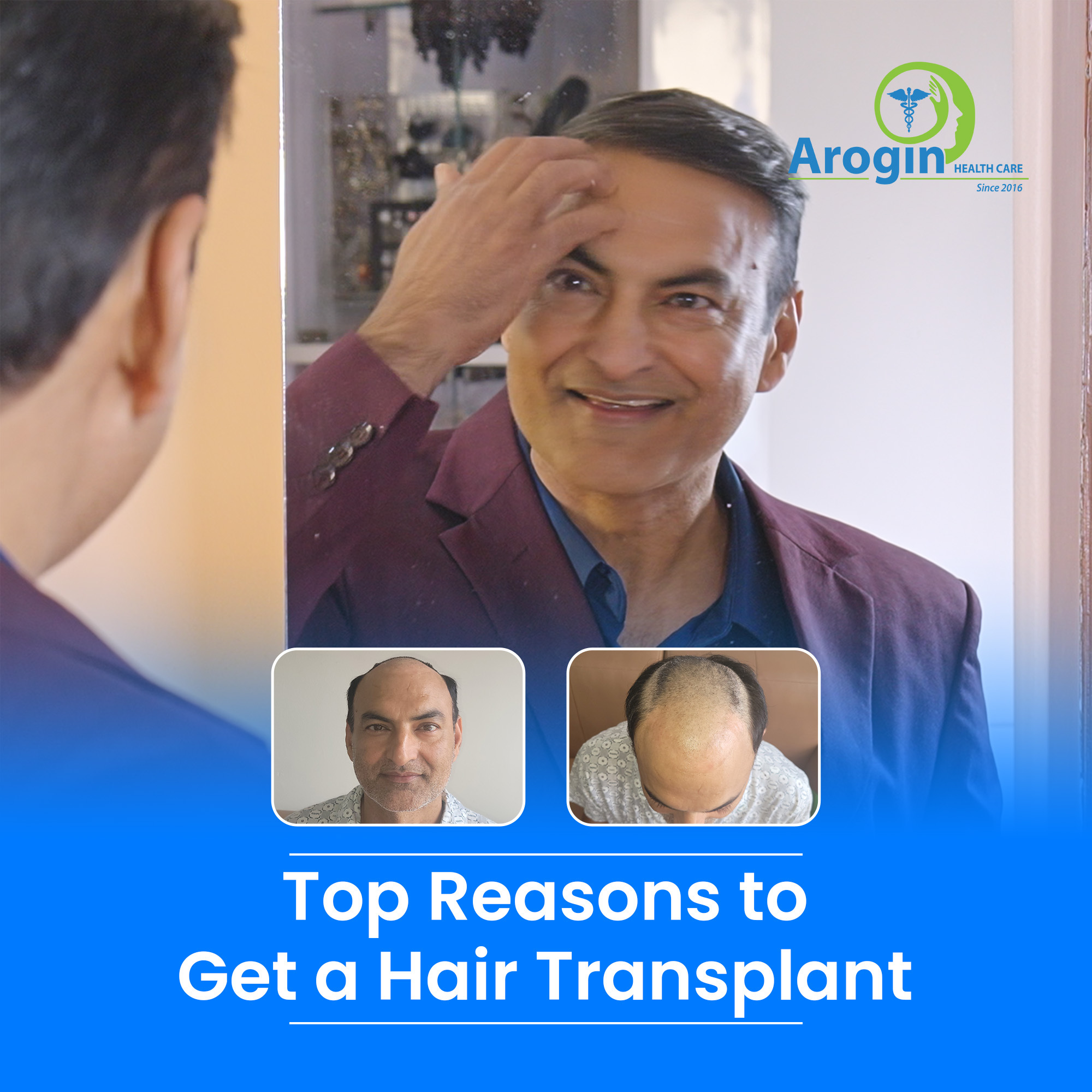 Top Reasons to Get a Hair Transplant